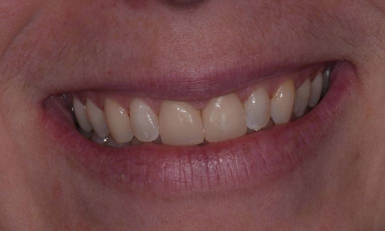 Veneers-After-Image