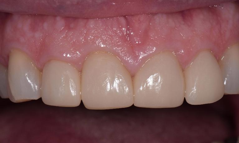 Cosmetic-Crowns-After-Image