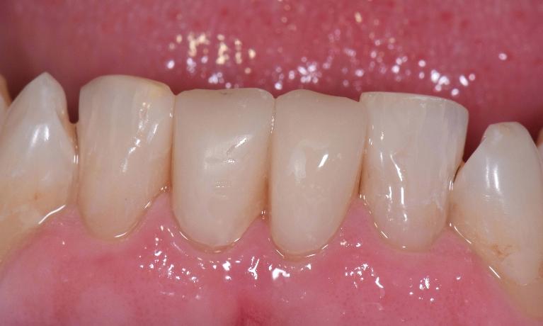 Tooth-Colored-Crowns-and-Fillings-After-Image