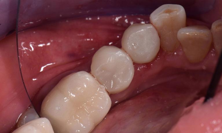 Tooth-Colored-Fillings-After-Image