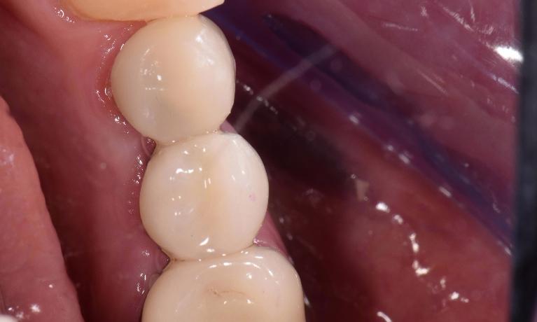 Tooth-Colored-Crown-After-Image