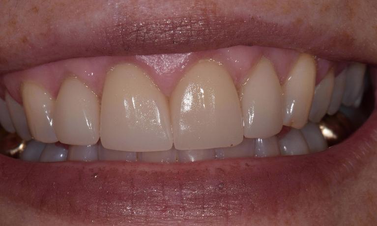Veneers-After-Image