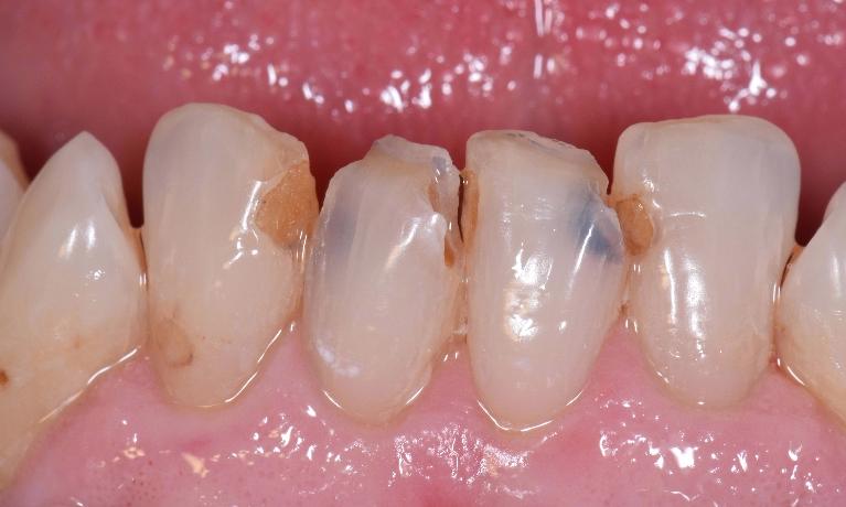 Tooth-Colored-Crowns-and-Fillings-Before-Image