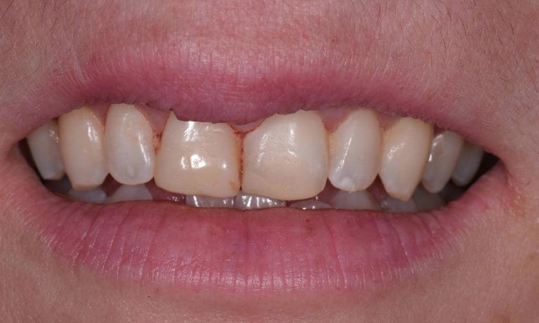 Veneers-Before-Image