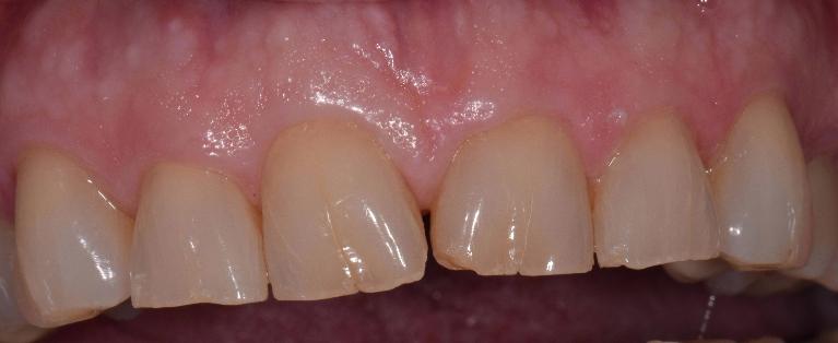 Cosmetic-Crowns-Before-Image