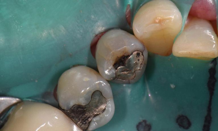 Tooth-Colored-Fillings-Before-Image
