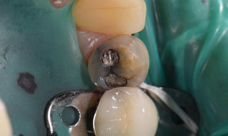 Tooth-Colored-Crown-Before-Image