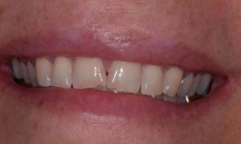 Veneers-Before-Image